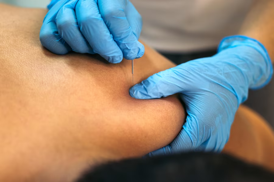 Dry Needling Therapy