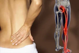 Sciatica Pain