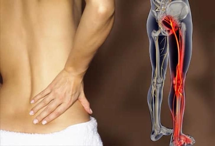 Sciatica Pain